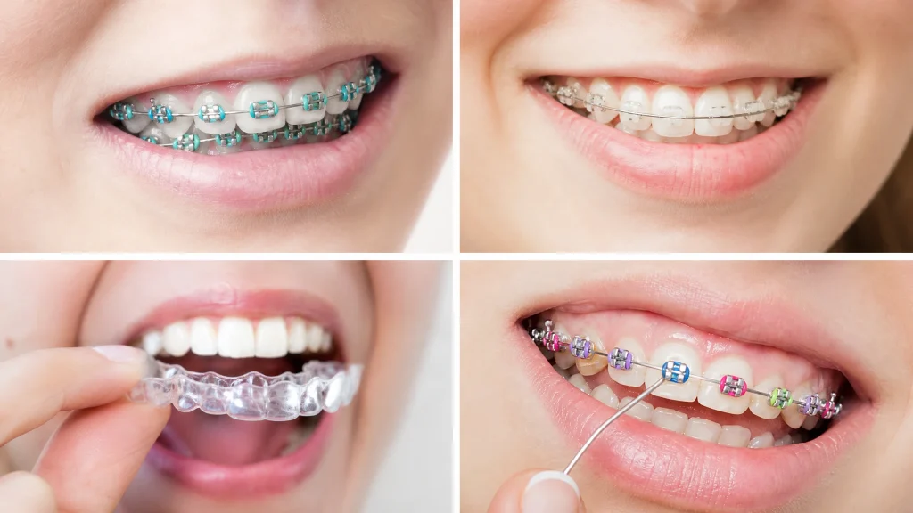 Appareils orthodontiques pour enfants et adolescents : aperçu des options