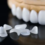 Veneers: Was sie sind und für wen sie geeignet sind