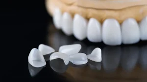 Veneers: Was sie sind und für wen sie geeignet sind