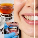 Zahnverfärbungen durch Kaffee und Tee: Ursachen, Hilfe und Bleaching